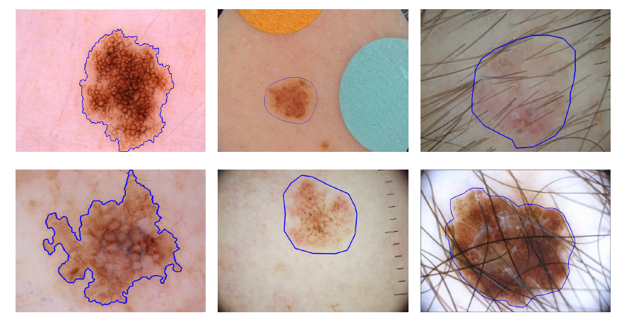 melanoma dermoscopy